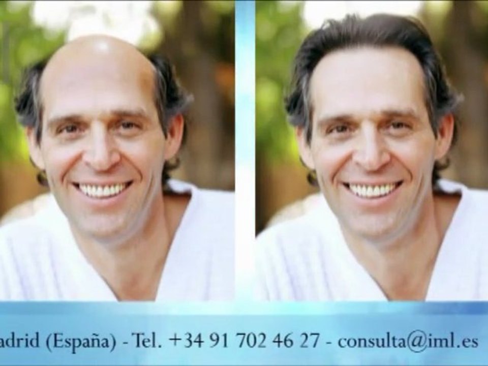 Microinjerto capilar en Madrid