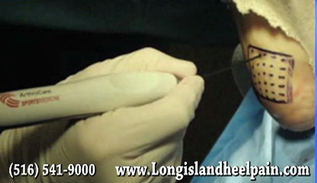 TOPAZ for Heel Pain - Podiatrist in Massapequa and Nassau County, NY