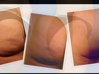 Cura de la celulitis, tratamiento natural celulitis, ...
