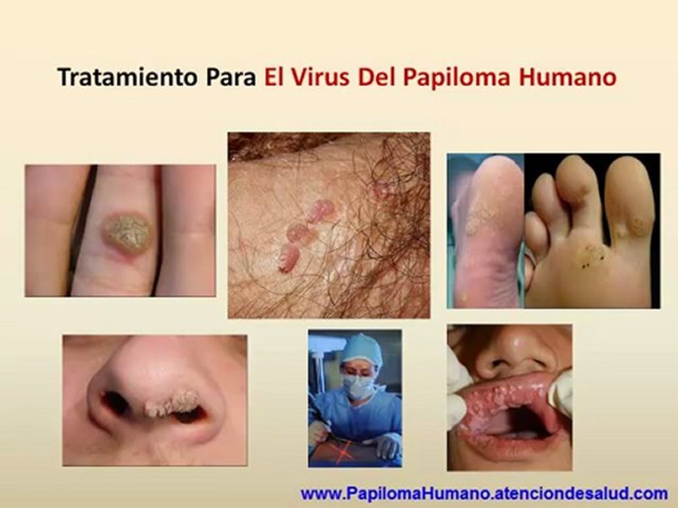 Tratamiento Para El Virus Del Papiloma Humano