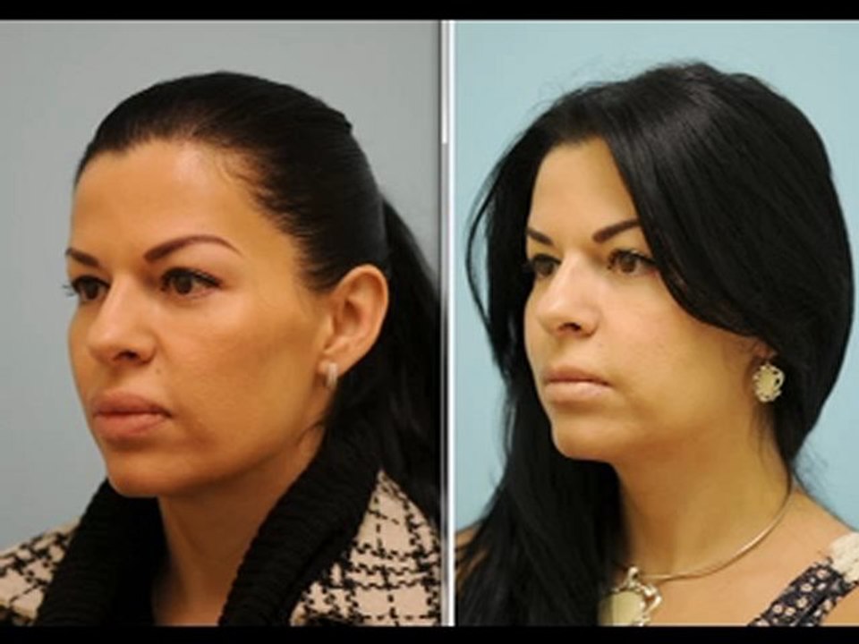 Lip Correction/Lip Reduction for Bad Silicone Lips Testimonial