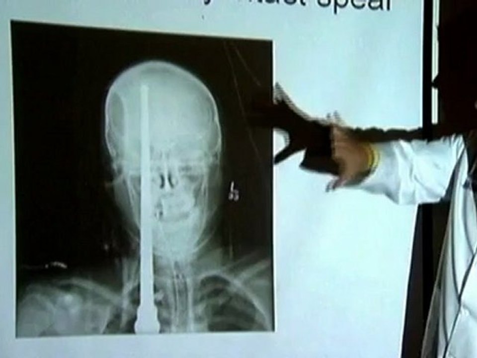 Teenager survives spear through the head.