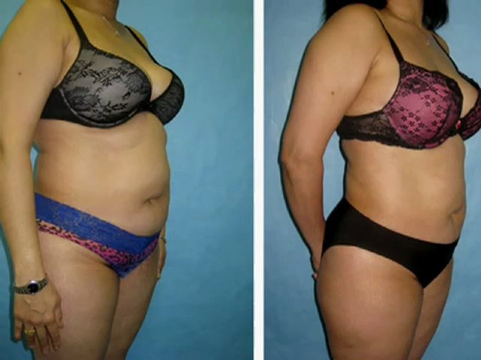 Plastic Surgeon Explains Liposuction in Westchester, NY