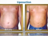 La Jolla/San Diego Body Contouring – Liposuction