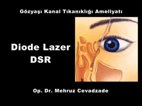 Göz Yaşı ve Kanal Tıkanıklığı Tedavisi