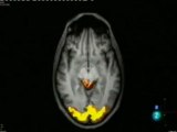 Acromatopsia: Oir los colores (Plasticidad cerebral, RMf)