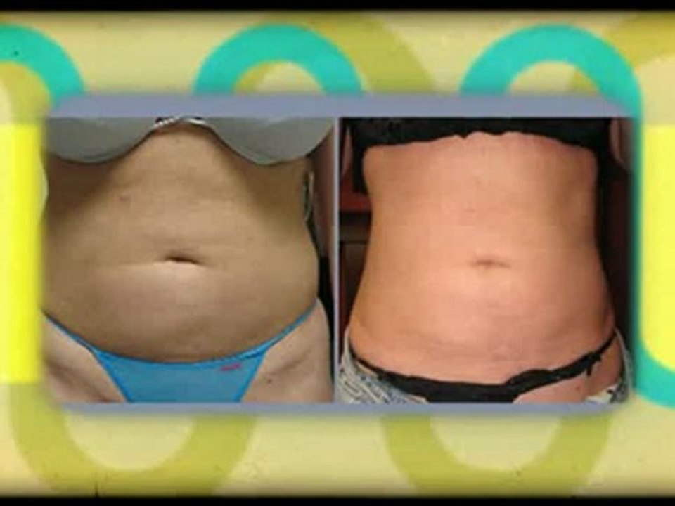 Is SmartLipo a Safe Procedure?