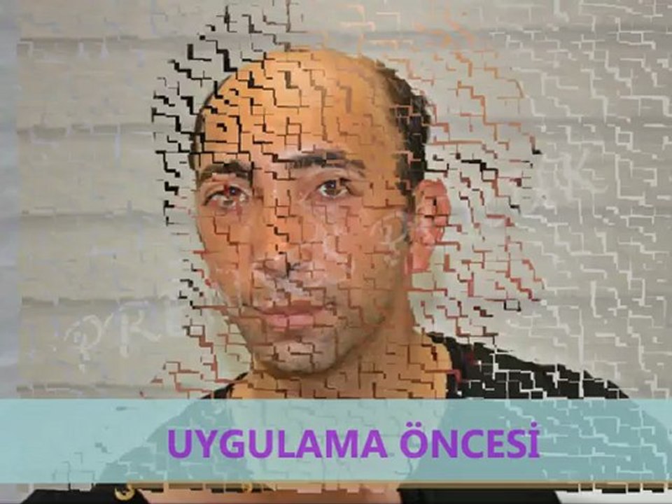 Prenses Peruk- Protez Saç Uygulaması- Saç Sorunları Merkezi Ankara- 0312 419 3707