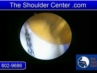 Shoulder Pain Surgery Best Shoulder Surgeon