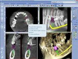 3D Implant Library Using Generic Crown Library