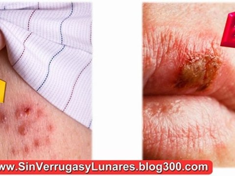 Como Quitar Las Verrugas - Como Eliminar Los Lunares