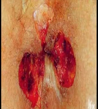 Como curar las hemorroides en 48 horas o menos, naturalmente