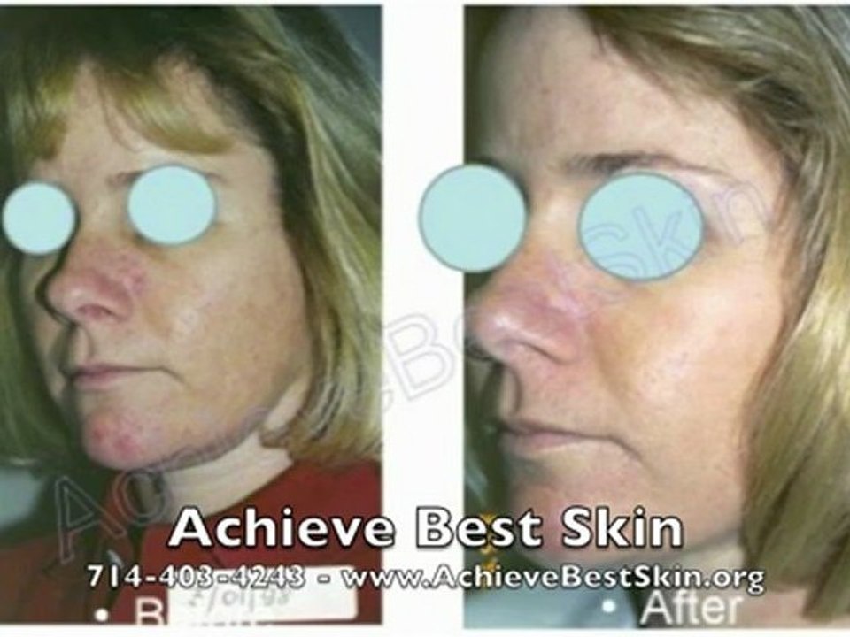 Achieve Best Skin 714-403-4243 Costa Mesa CA Skin Care Services