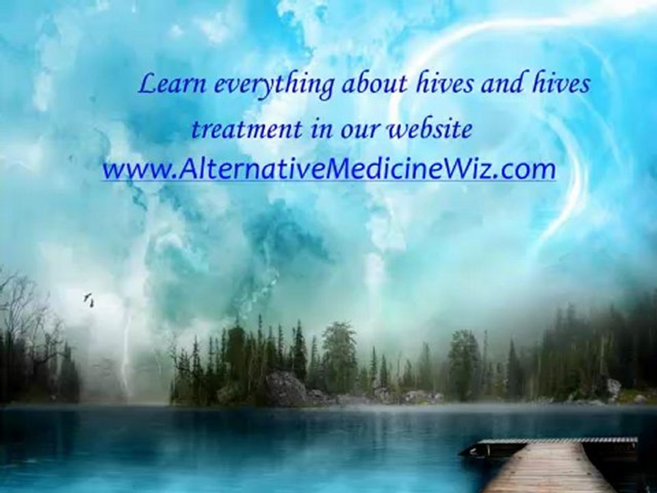 Chronic Urticaria - Hives, Symptoms, Causes and Natural Treatment
