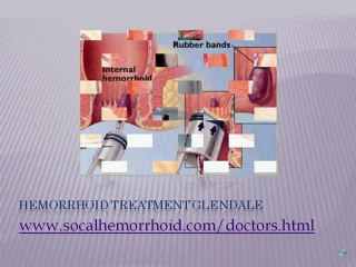 Best Hemorrhoid Treatment In Los Angeles
