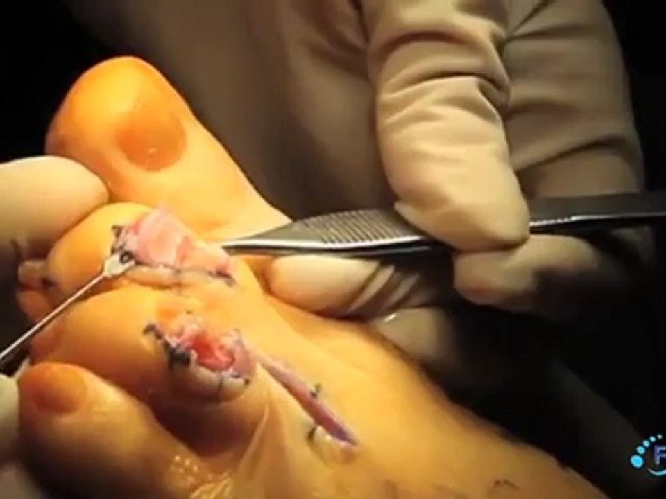 HammerToe Fusion Reamer Surgery Shortened