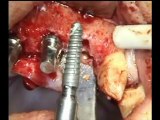 Implants dentaires - Chirurgie : Pose de 4 implants - CAS MAI 2011 - Drive Implants