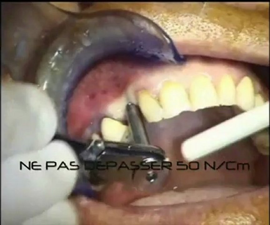 Implants dentaires - Chirurgie : Technique Transmuqueuse - CAS AVRIL 2011 - Drive Implants