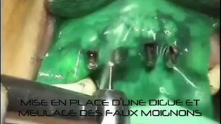 Implants dentaires - Chirurgie : 2eme Temps chirurgical 4 implants - CAS MAI 2011 - Drive Implants