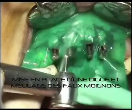 Implants dentaires - Chirurgie : 2eme Temps chirurgical 4 implants - CAS MAI 2011 - Drive Implants