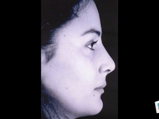 Rhinoplastie: les résultats possibles