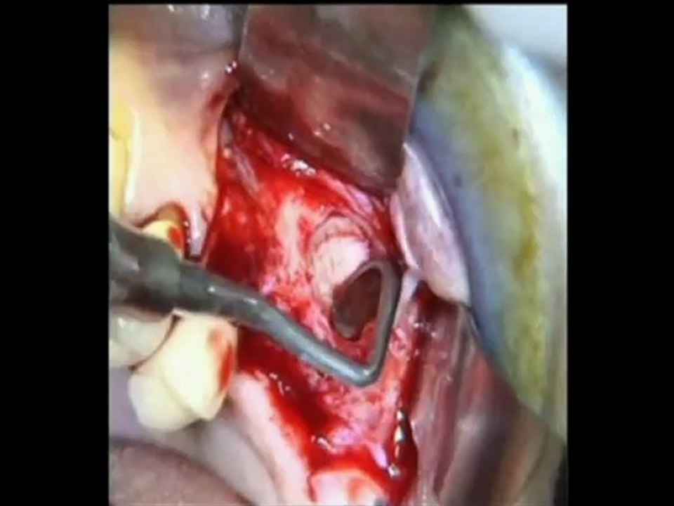 Implants dentaires - Chirurgie : Sinus lift et Substitut osseux - CAS SEPT 2011 - Drive implants