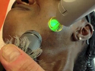 epilation definitive visage peau noire