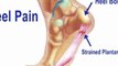 Heel Pain - Podiatrist Fort Myers, Cape Coral , Lee County, Fl