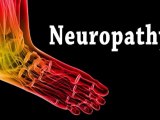 Peripheral Neuropathy - Podiatrist - Fort Myers, Cape Coral,  Lee County, Fl