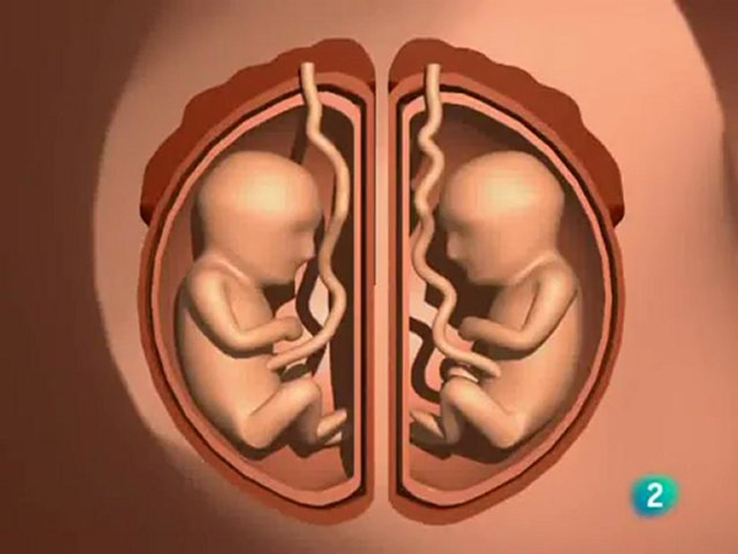 Separacion gemelar: Placenta y cordon umbilical - Vídeo Dailymotion