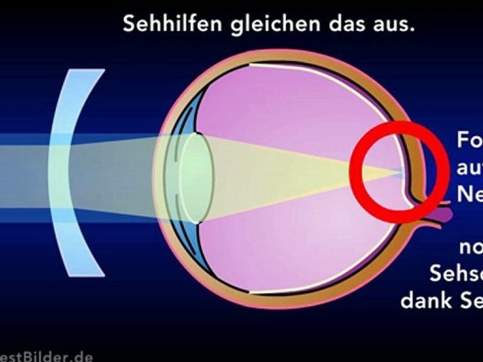 Kurzsichtigkeit - Was ist das?
