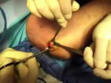 Florida Hand Center: Ulnar Nerve Decompression (endoscopic assisted)