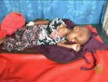 معاناة الأطفال المتضررين من الجفاف بالصومال