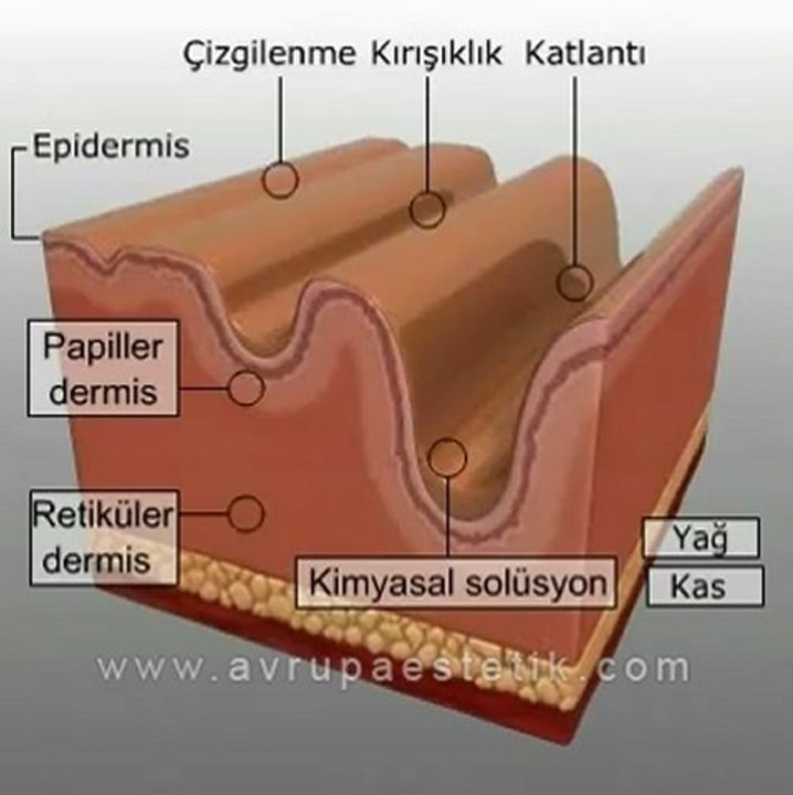 Orta Dereceli Kimyasal Peeling