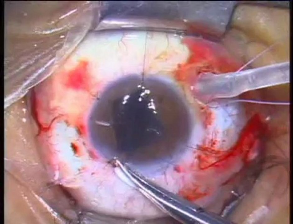 Lost-in-Vitrectomy-South-of-the-Border-Approach