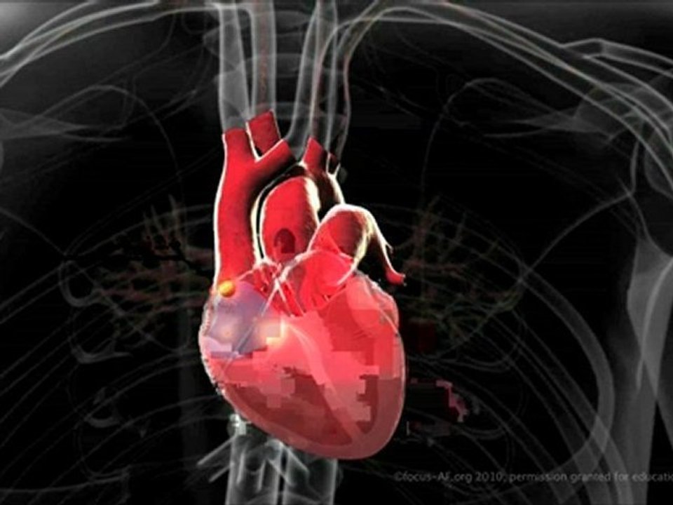 Qu'est-ce que la fibrillation atriale (ou fibrillation auriculaire) ?