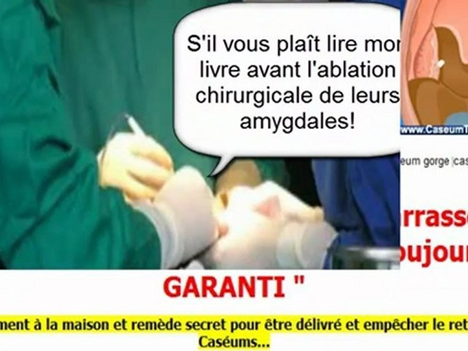 caseum amigdalar - amygdales - amygdales cryptiques