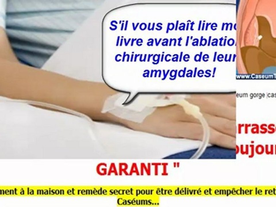 ablation des amygdales - opération des amygdales