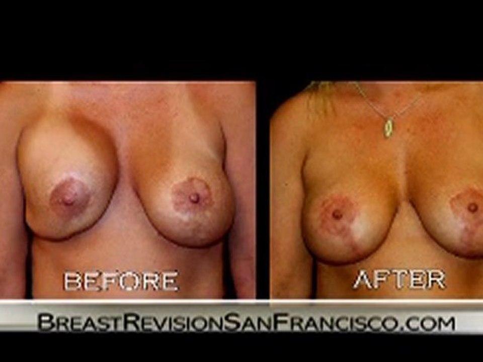 Breast Augmentation Revision Documentary-2Womens Story-FINAL