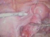 Salpingostomi yani tüpün çizilmesi yöntemiyle laparoskopik (kapalı ameliyat) dış (ektopik) gebelik ameliyatı