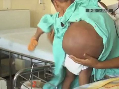 Enfant mexicain avec une tumeur 15 kilos
