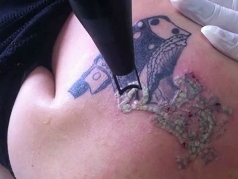 Pastelle Q-swicth lazer dövme silme