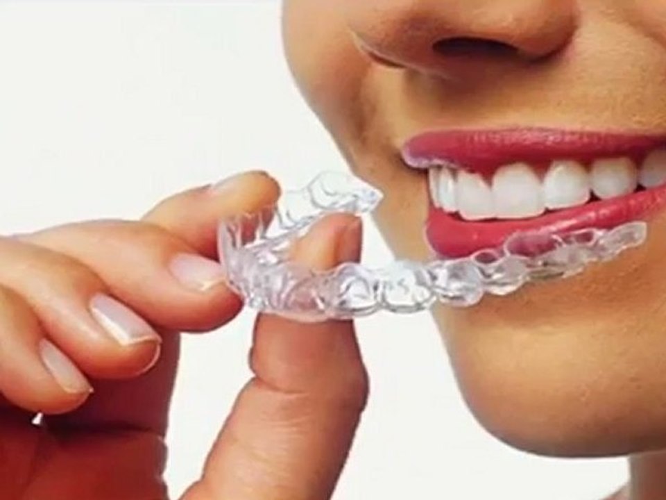 Invisalign - clear braces - Dr. David Brown Burlington Dentist