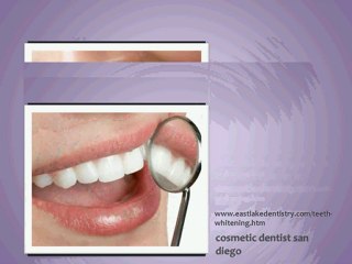 Dental Implants in San Diego