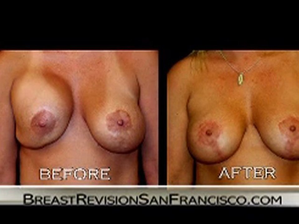 Breast Augmentation Revision Documentary-2Womens Story-FINAL