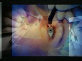 Vision after LASIK surgery
