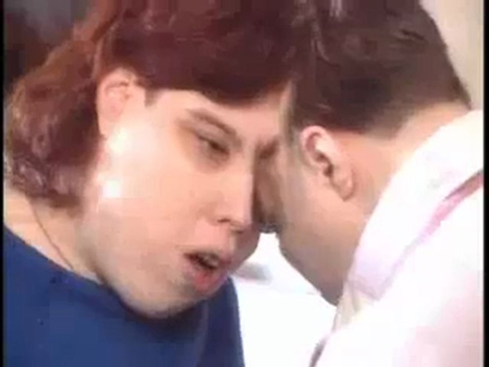 Siamois collés par la tête