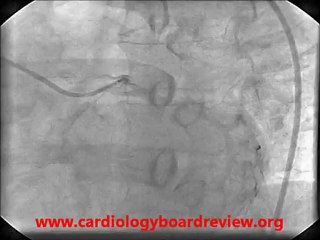 Single Coronary Artery - Single Left Coronary
