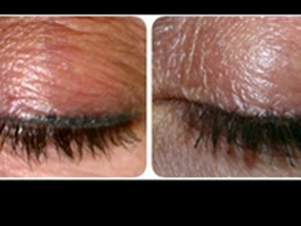 Davie Laser Hair removal