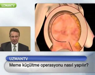 Meme Küçültme Operasyonu Nasıl Yapılır?